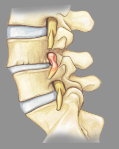 discectomy los angeles effects